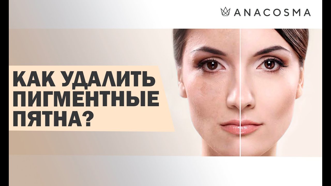 ЭТО ВАЖНО ЗНАТЬ ❗️ УДАЛЕНИЕ ПИГМЕНТНЫХ ПЯТЕН 🔥 ANACOSMA