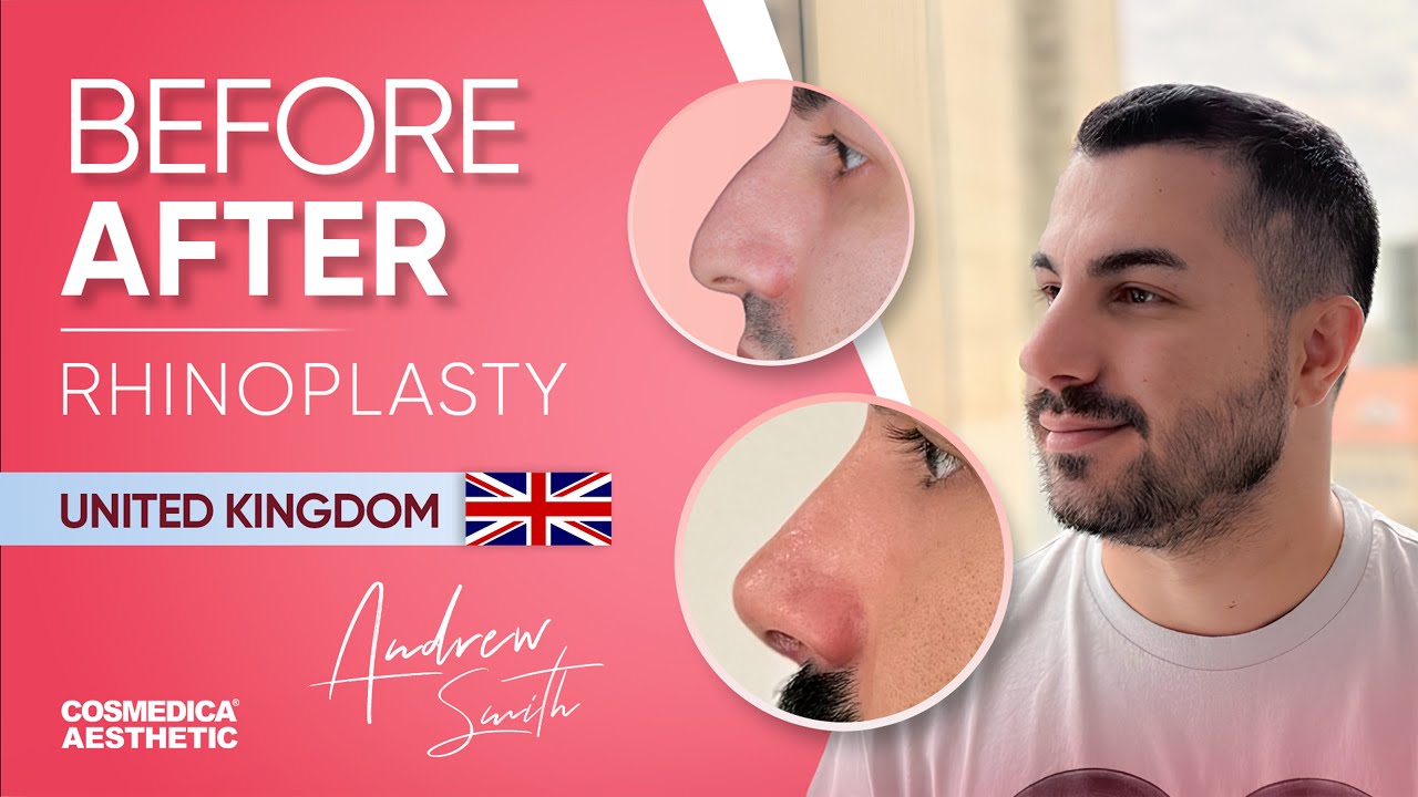 Andrew Smith UK Patient Rhinoplasty Operation Review | Cosmedica Aesthetic | Nose Job Vlog Turkey