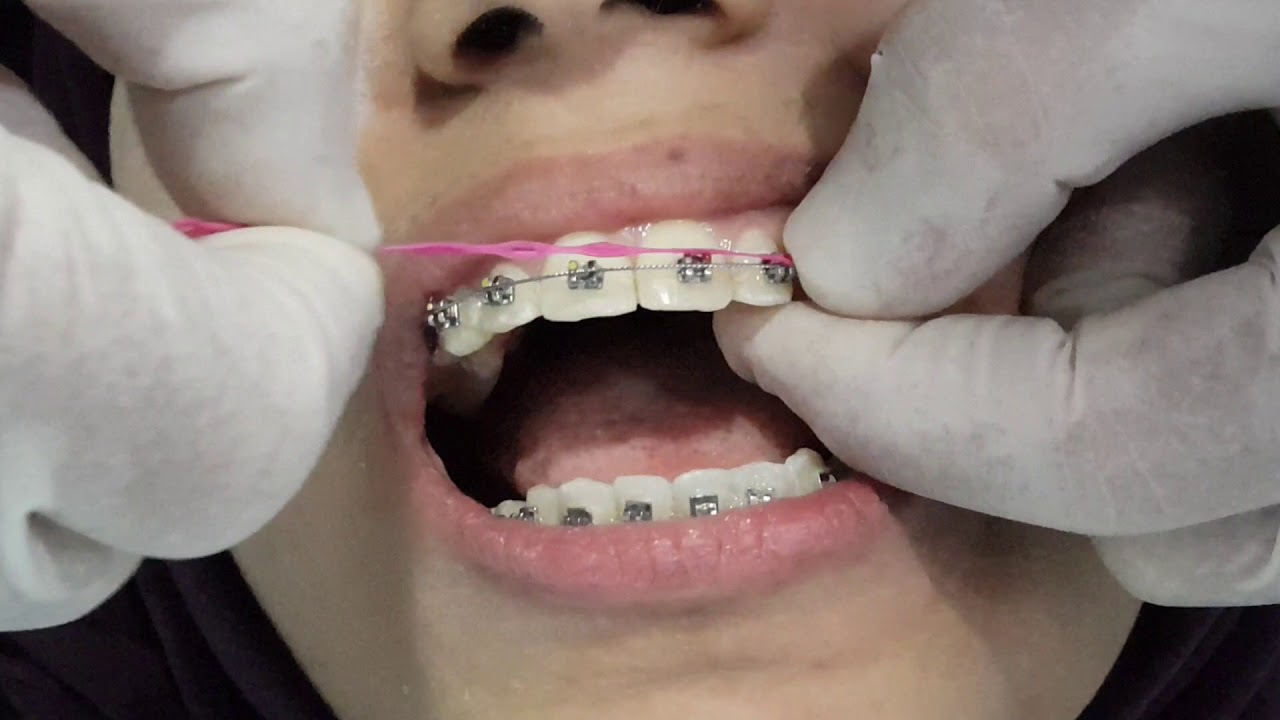 تقويم الاسنان  المريح والممتع والسريع مع Dental NLP