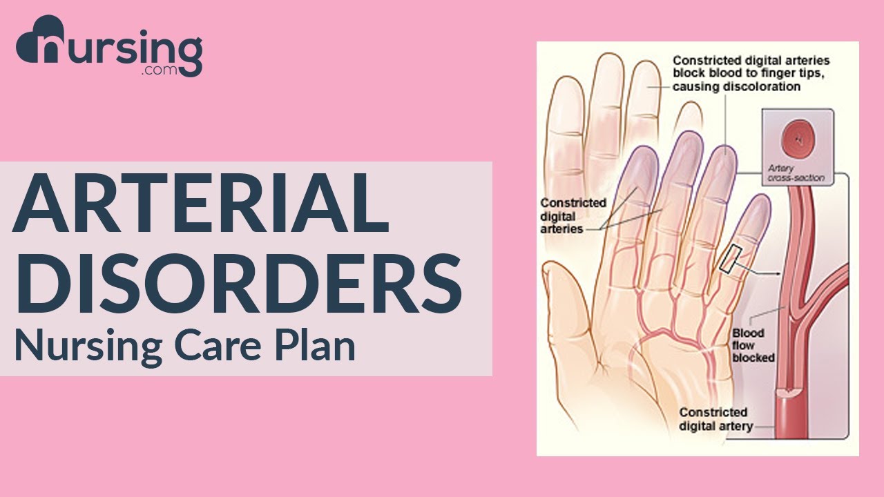 What are ARTERIAL DISORDERS and how to care for them as a nurse... Nursing Care Plan