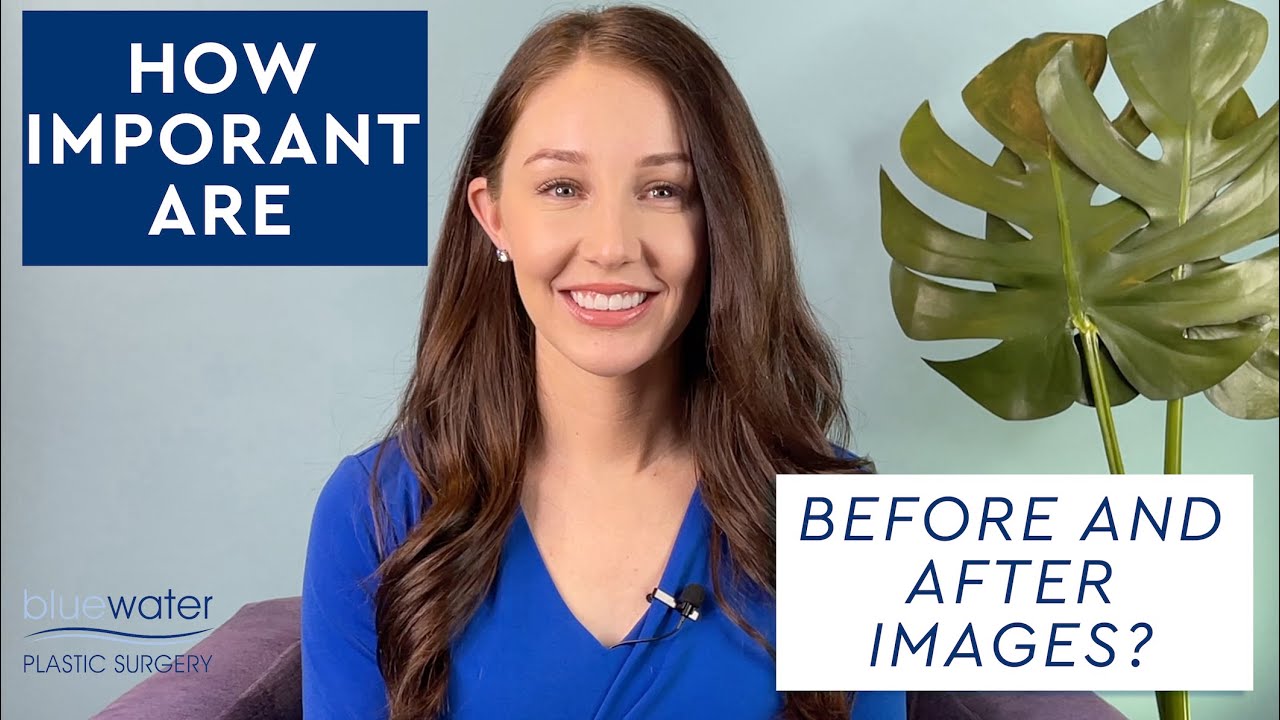 How Important are Before and After Images | Plastic Surgery Raleigh | Blue Water Plastic Surgery