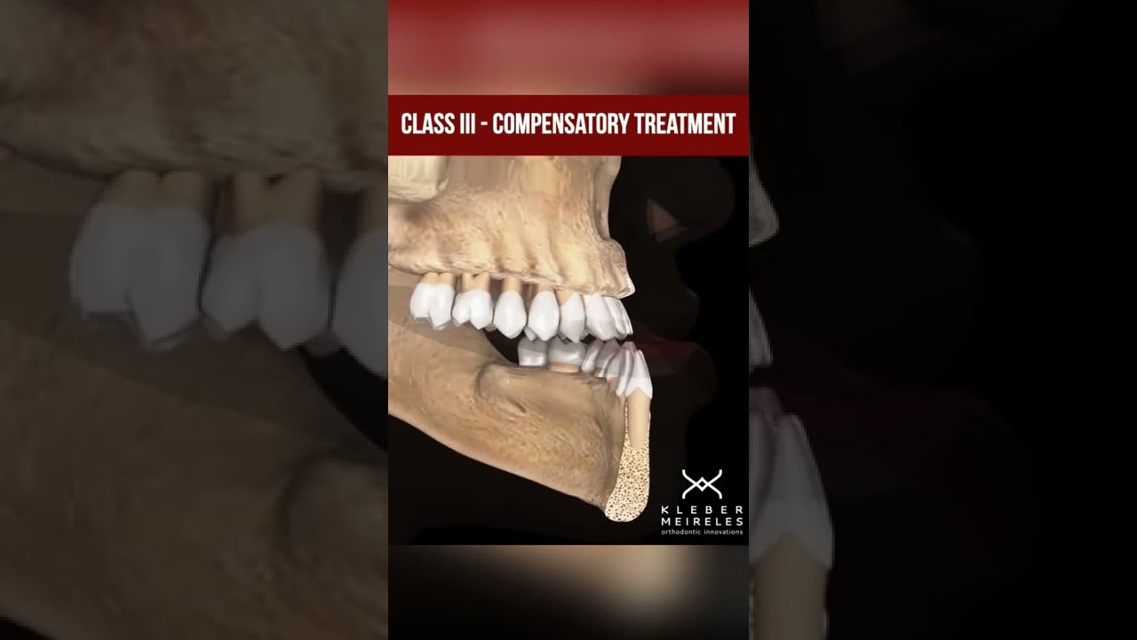 CLASS ||| - COMPENSATORY TREATMENT - ORTHODONTIC TIPS #Shorts