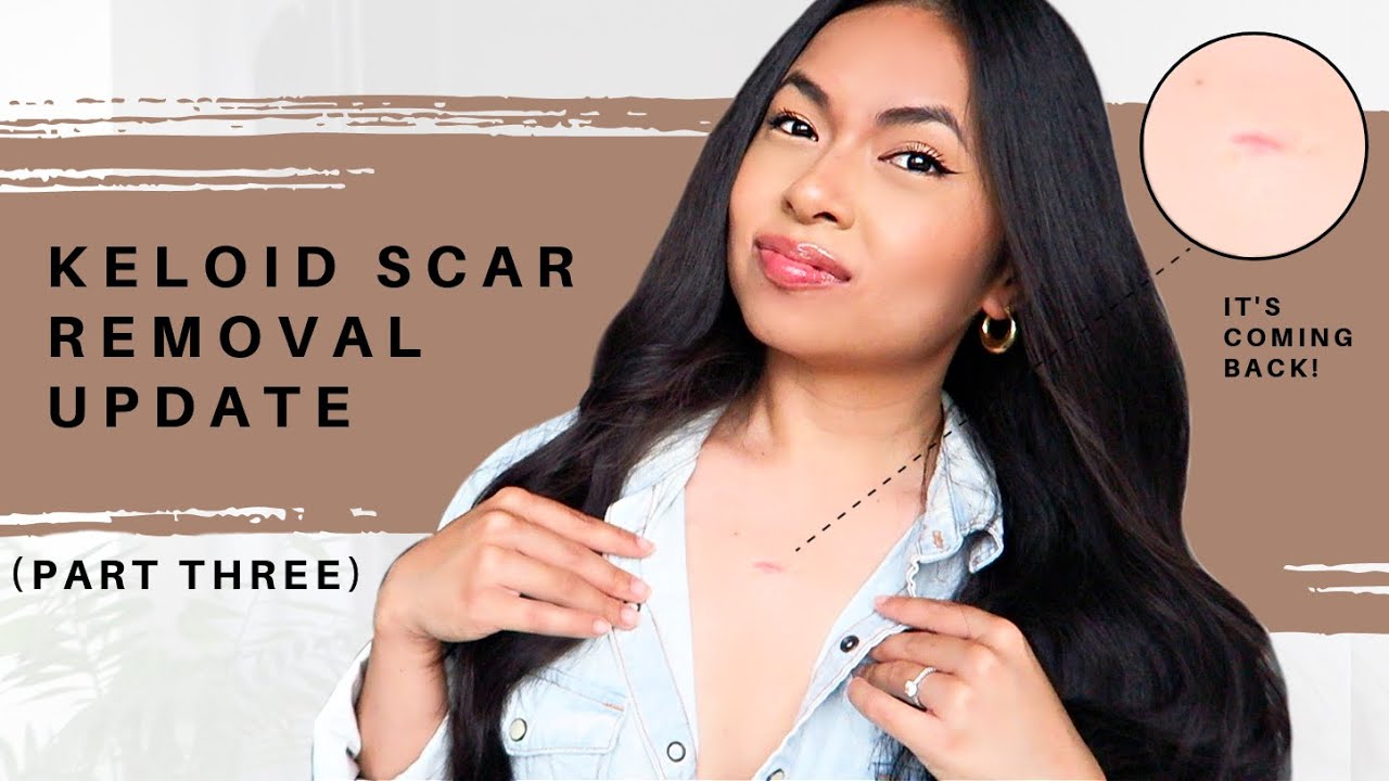 KELOID SCAR REMOVAL (PART 3) - STEROID INJECTION (NO SURGERY) @JulieAbcede