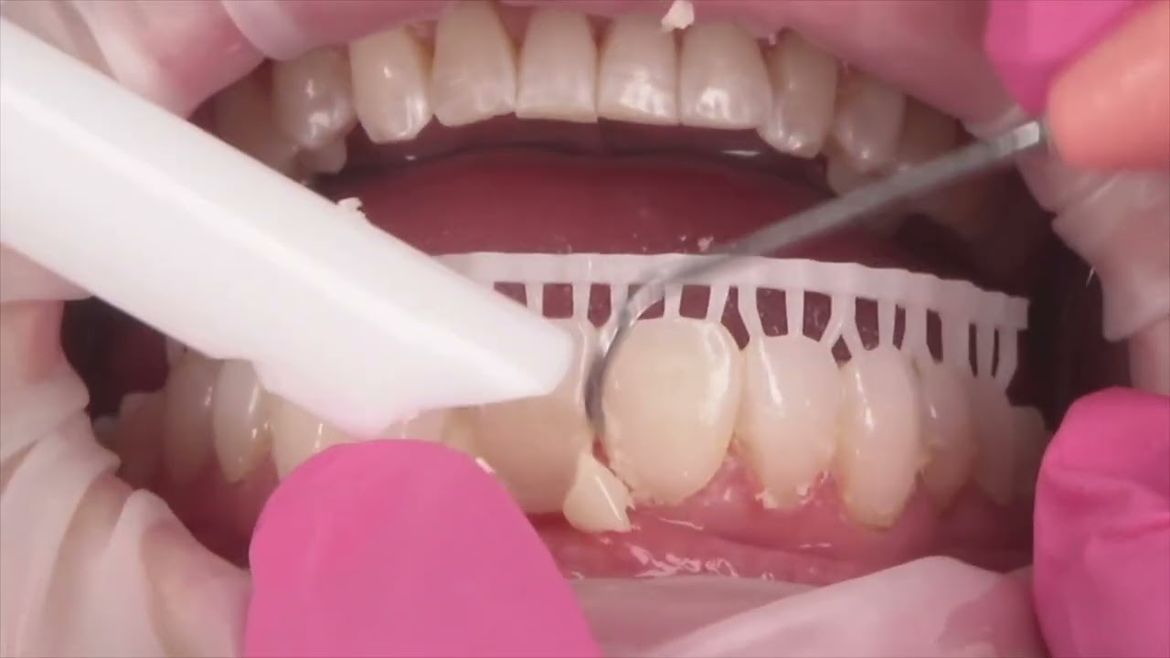 The worlds easiest Veneer Provisionals 