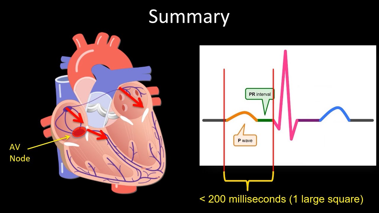How to Read an ECG: Examining the PR Interval, PR prolongation, First degree AV block.