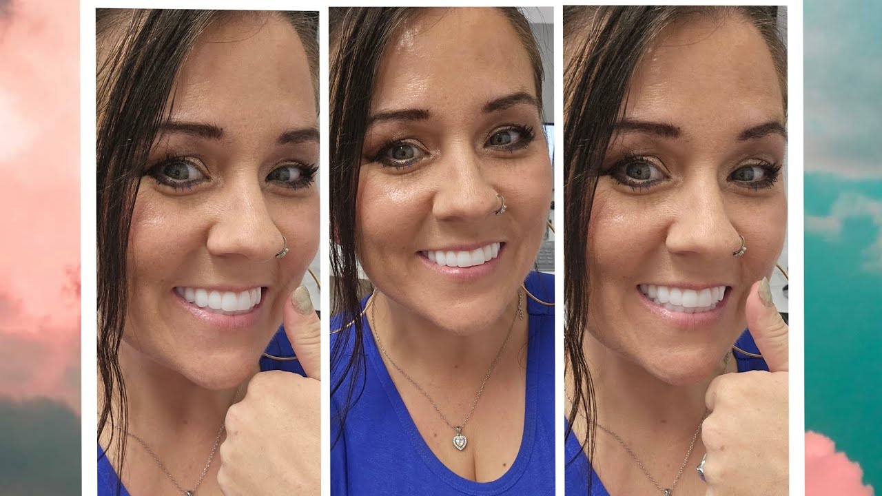 GETTING MY PERMANENT ZIRCONIA ALL ON 4 TEETH! (vlog style) July 10th, 2024. Part 2 😃