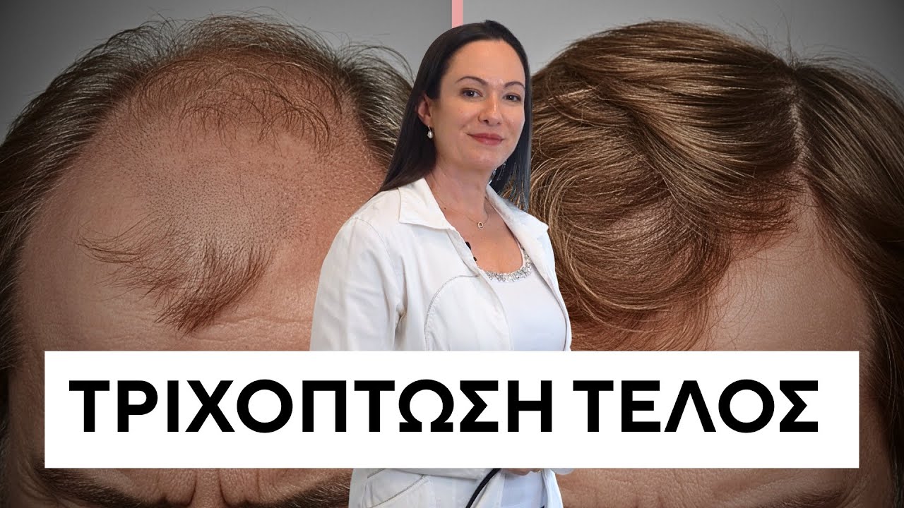 Τριχόπτωση: Γιατί το Καστορέλαιο Δεν Λειτουργεί & Τι να κάνετε | Δρ. Άννα Σταθοπούλου, Δερματολόγος