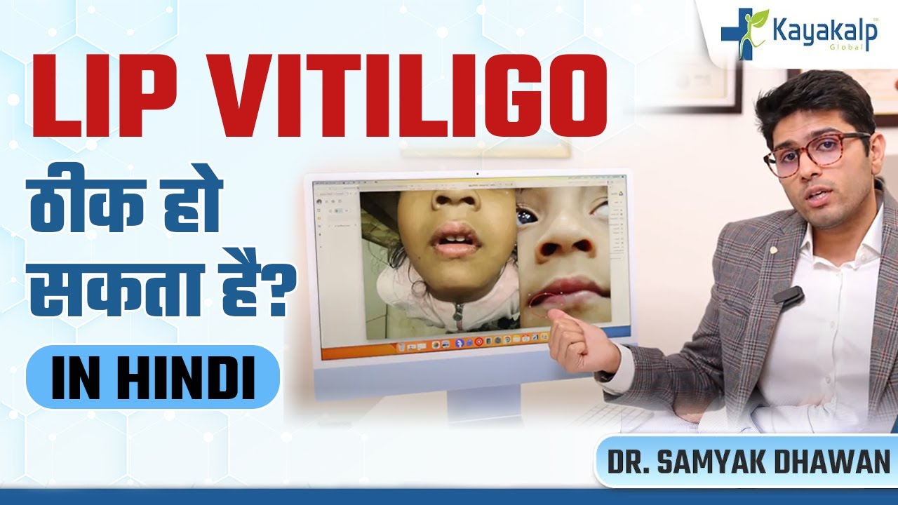 Lip Vitiligo ठीक हो सकता है? | Lip Vitiligo Treatment Case Study | Kayakalp Global