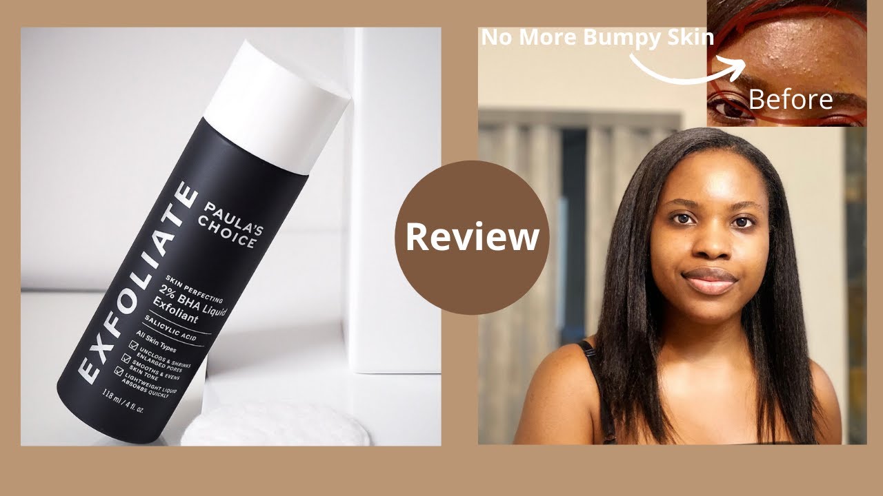 Watch This Before You Buy: Paula's Choice 2% BHA Liquid Exfoliant Review ⎪On Oily Acne Prone Skin