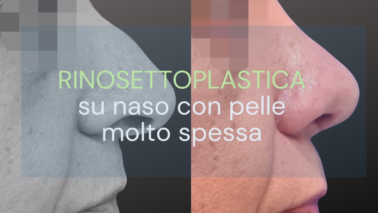 Caso di Rinosettoplastica su naso con pelle molto spessa