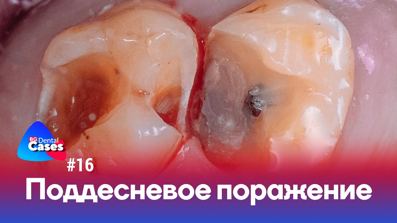Поддесневое поражение | Дентал Кейсы BG №16