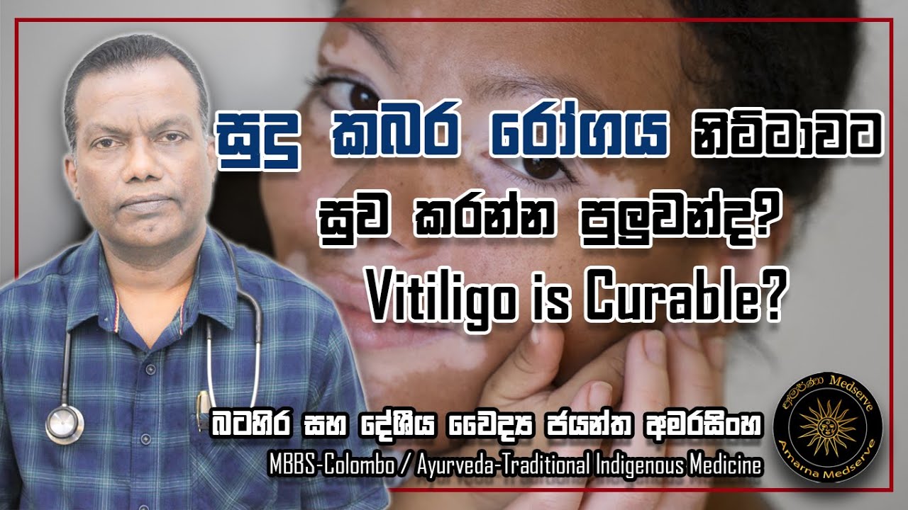 සුදු කබර රෝගය නිට්ටාවට සුව කරන්න පුලුවන් ද? | Vitiligo is Curable?