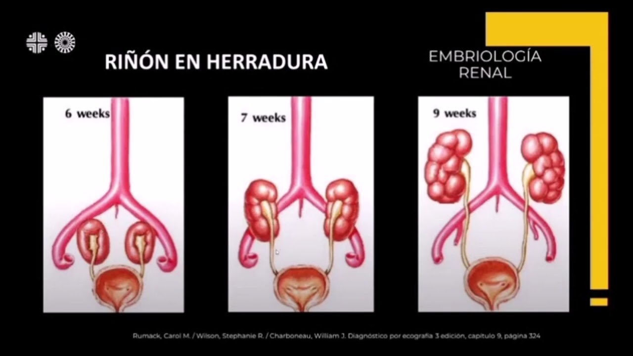 Caso Clínico 83: Riñón en herradura.