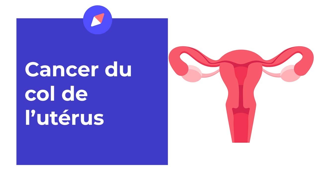 Cancer du col de l'ut&eacute;rus : sympt&ocirc;mes et traitements