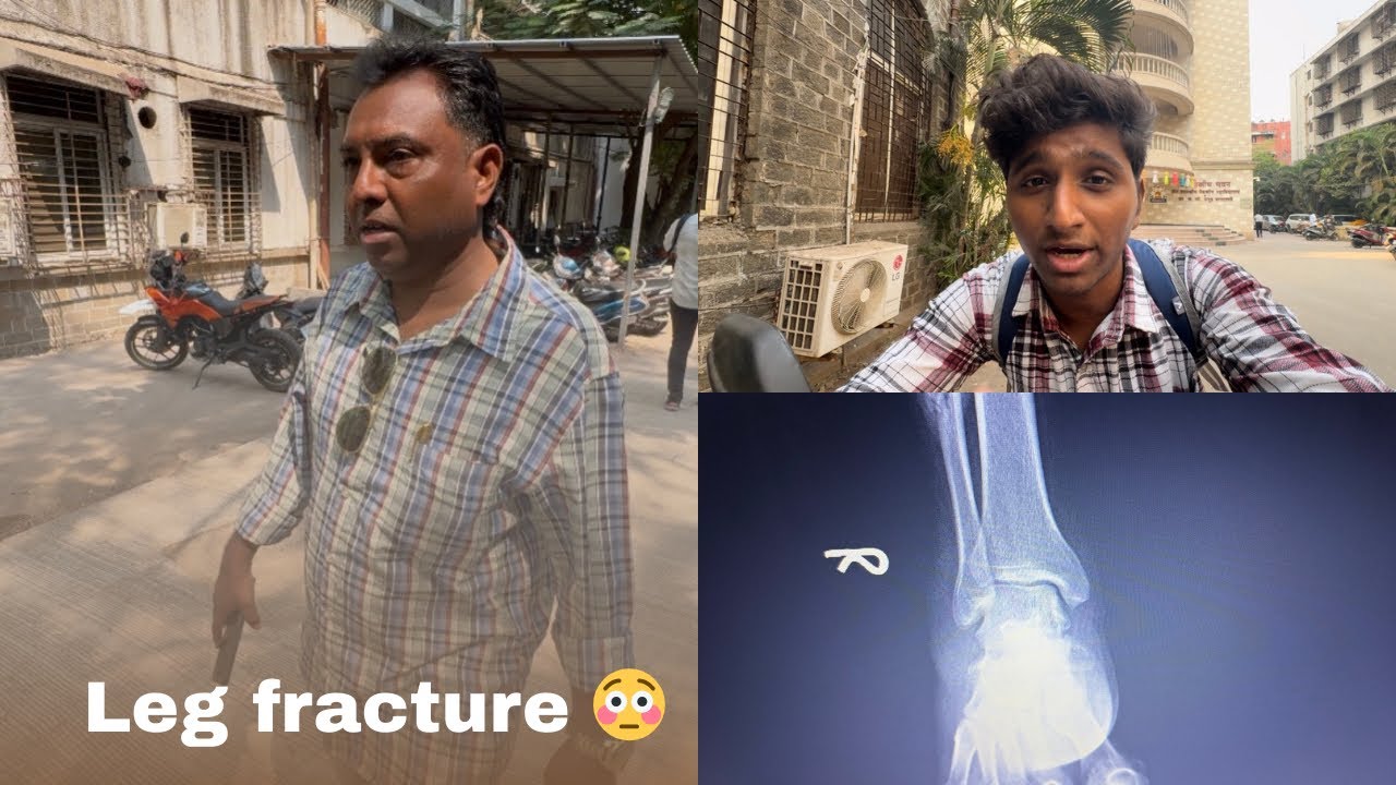 पप्पाचा पाय फ्रॅक्चर झाला आहे 😳| Pappa cha paay fracture Zala aahe 😳| Day 135 | 