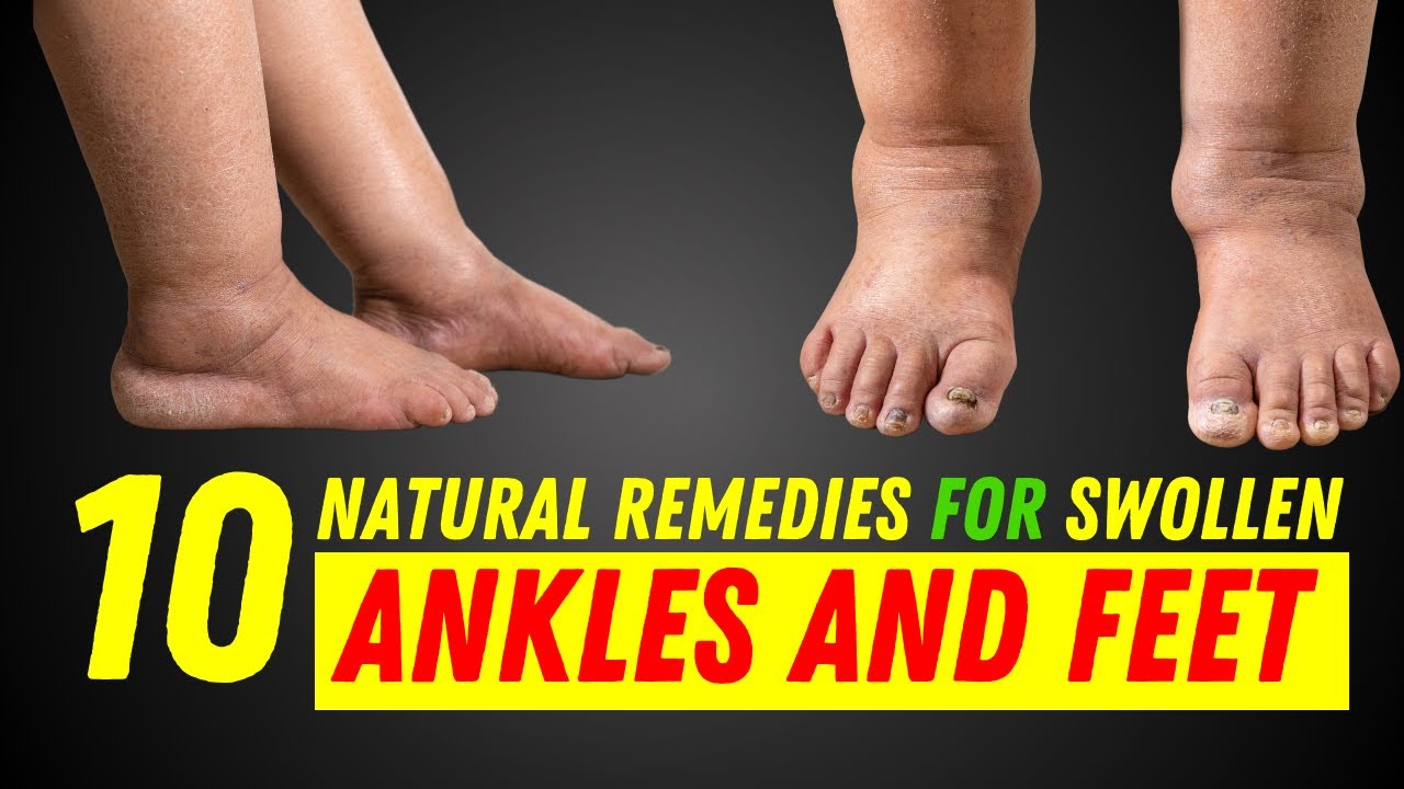 Top 10 Natural Remedies for Swollen Ankles and Feet, Beat Swollen Ankles and Feet