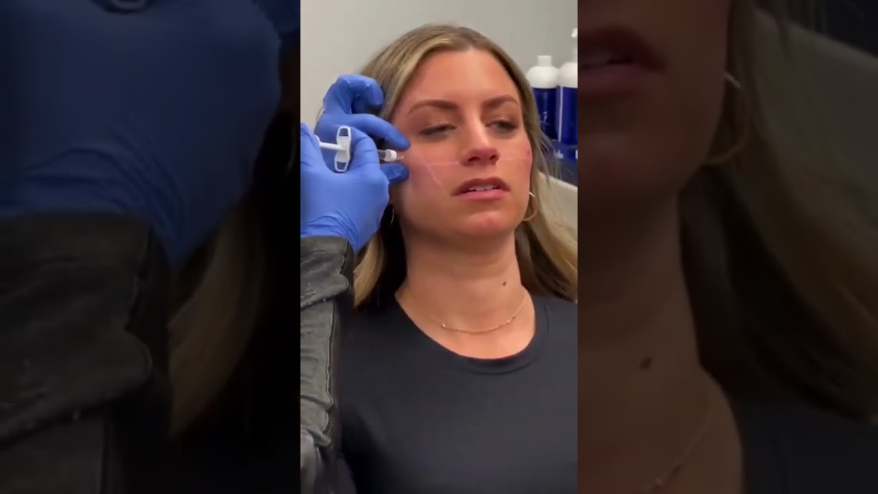Before & After Filler