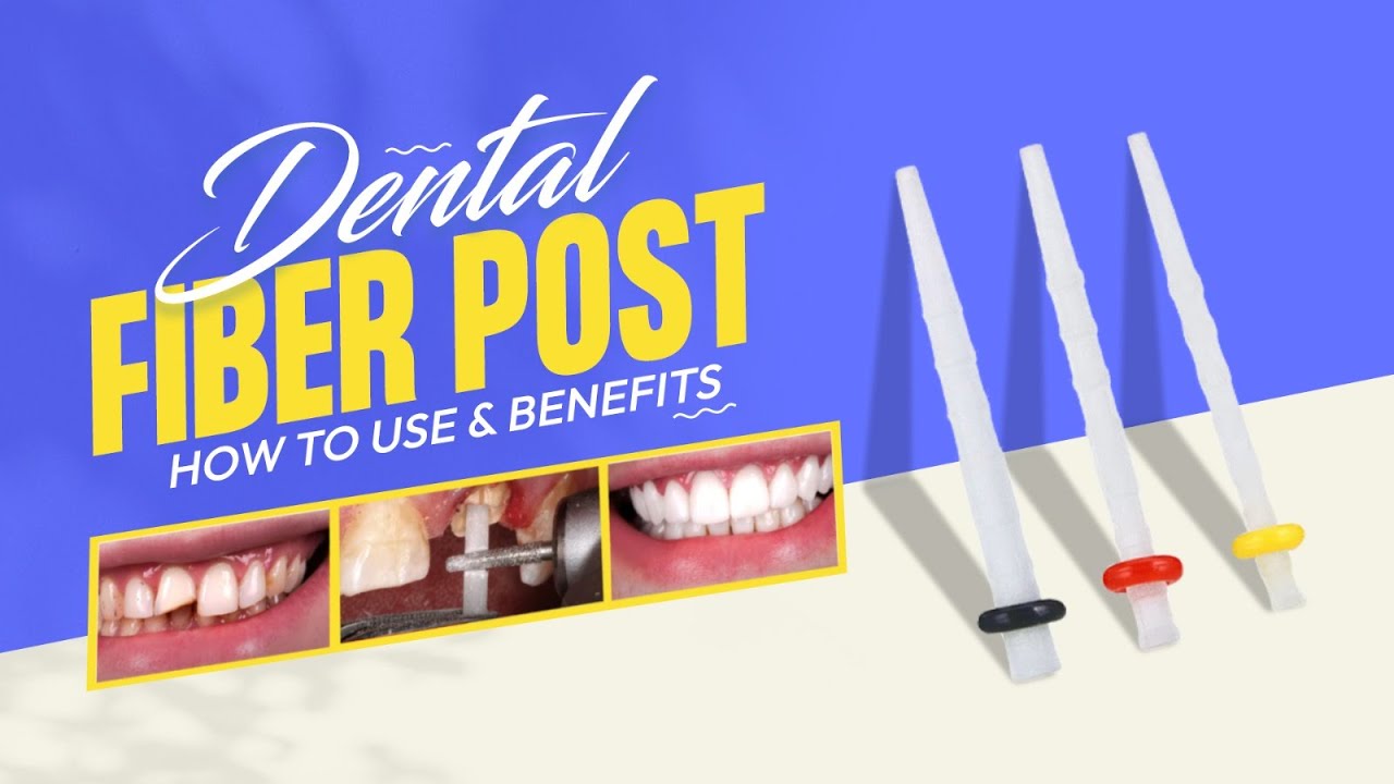 Dental Fiber Post | How To Use & Benefits | Dentalkart