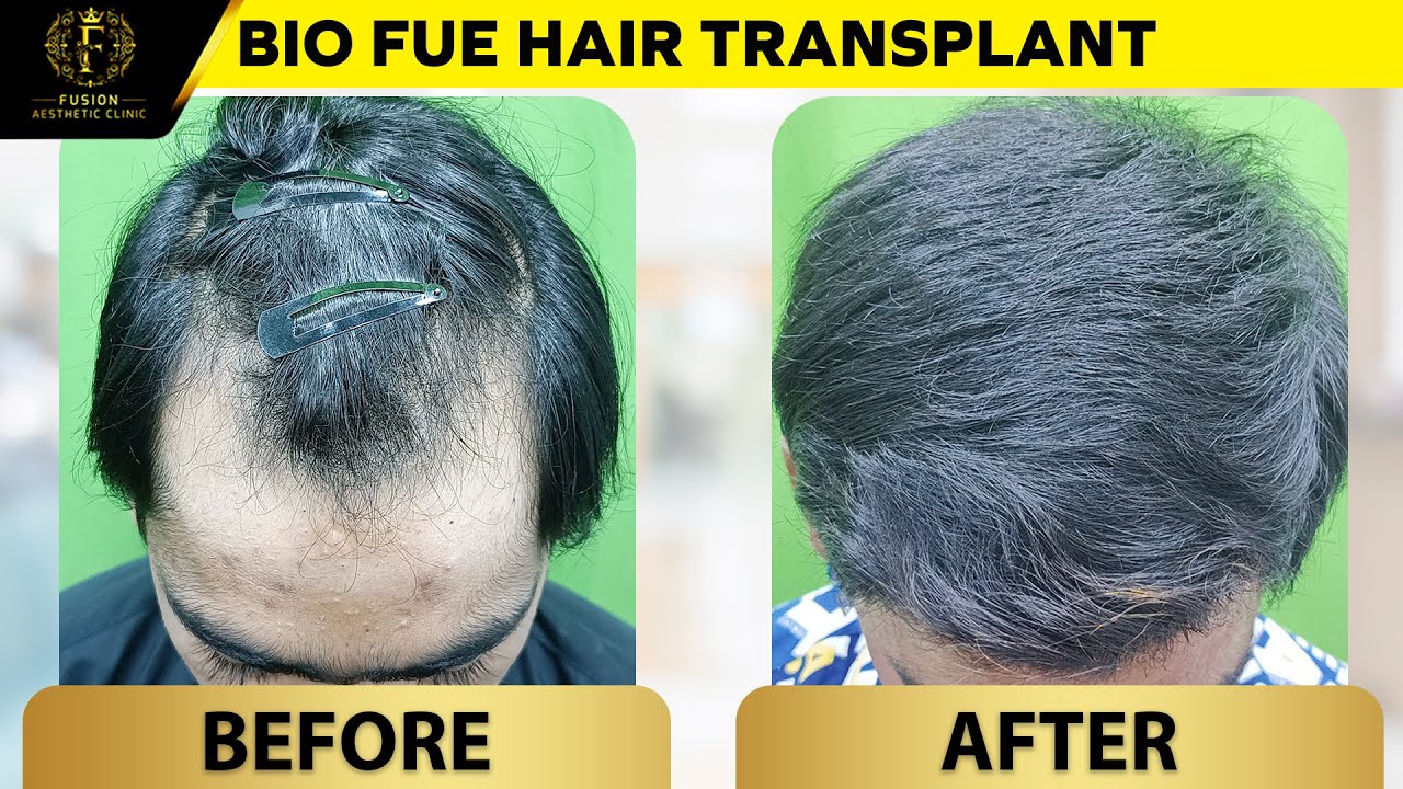 Receding Hairline And Temple Hair Transplant | Hairloss | Best Hair Transplant Results | | Dr.Pranil