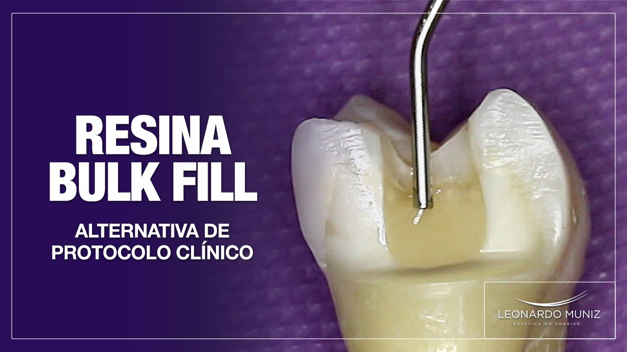 Resina Bulk Fill. Alternativa de protocolo clínico.