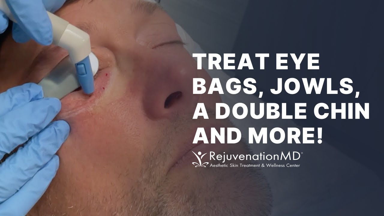 Agnes RF: Your Solution for Under Eye Bags