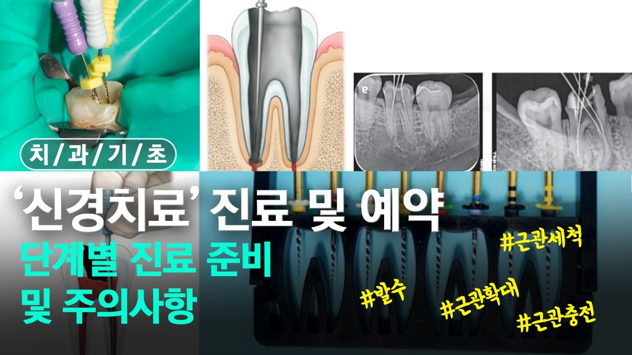 신경치료 치과치료 마스터 치과초보자분들 꼭 보세요😃