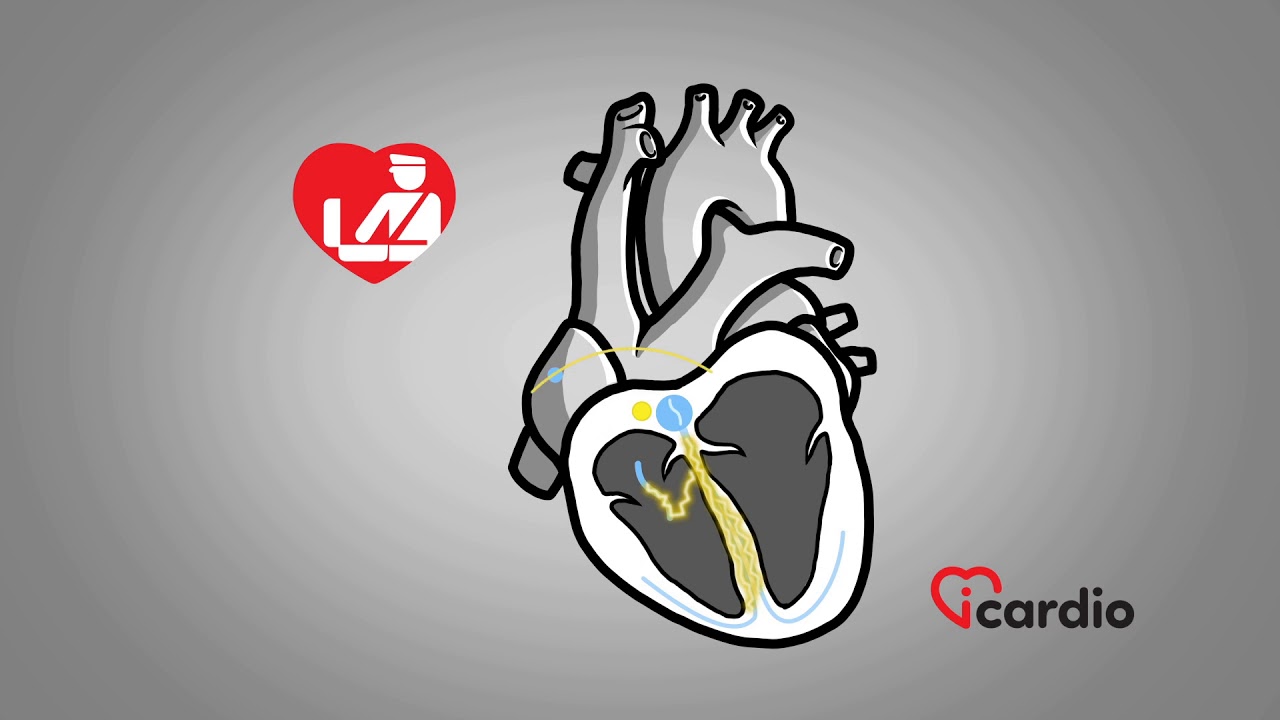 Supraventricular Tachycardia