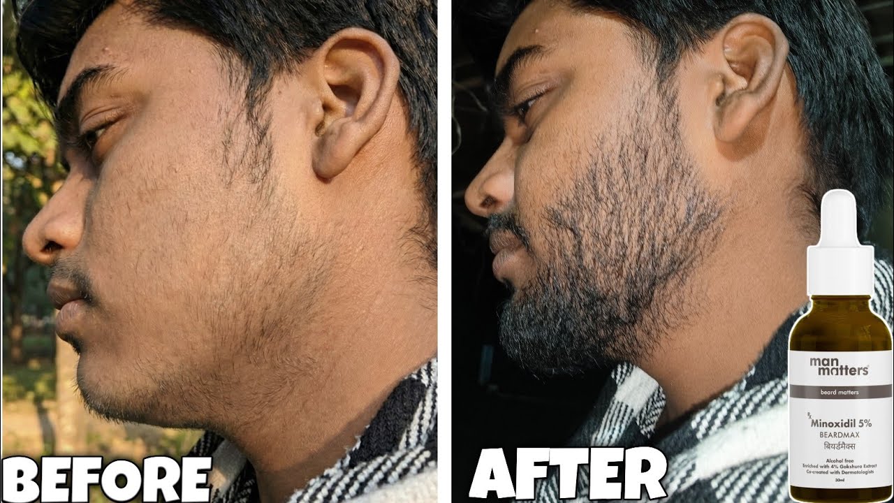 Minoxidil Ne Meri Beard Barbaad Kar Di… Kyun ? minoxidil beard growth mistake | minoxidil beard 2026