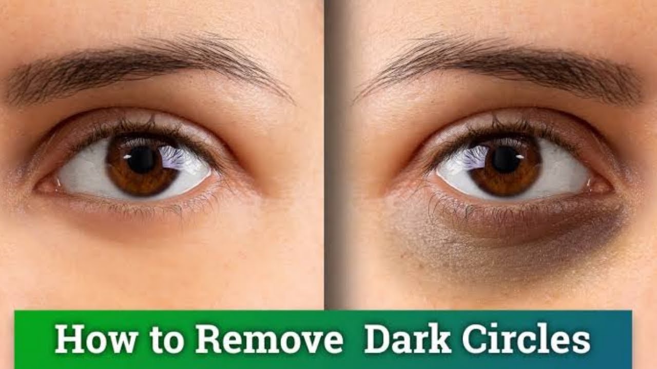 Remove Dark Circles in 4 days with Vitamin E (100%works)|BeautyUtsav