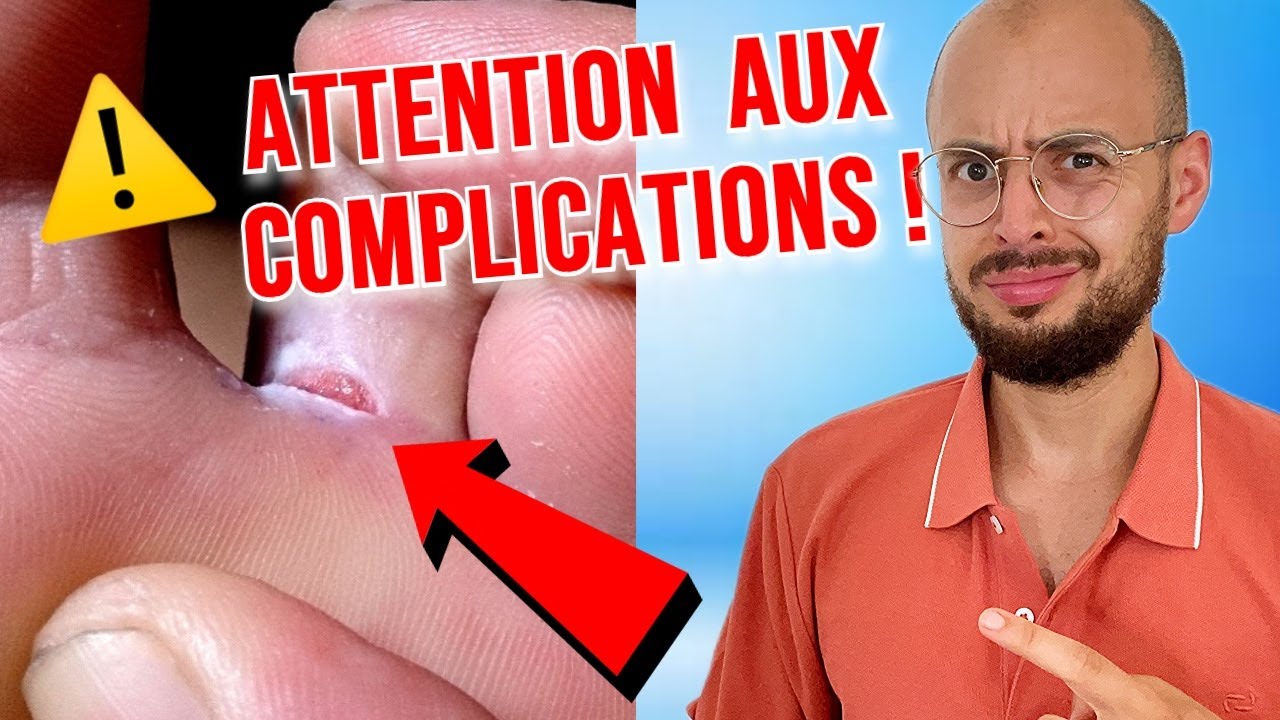 Mycose entre les orteils : pourquoi s'en méfier ?