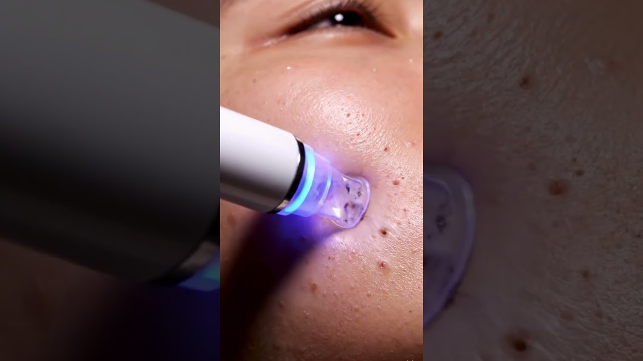 Satisfying Pore Vacuum: Watch My Deep Clean & Blackhead Removal