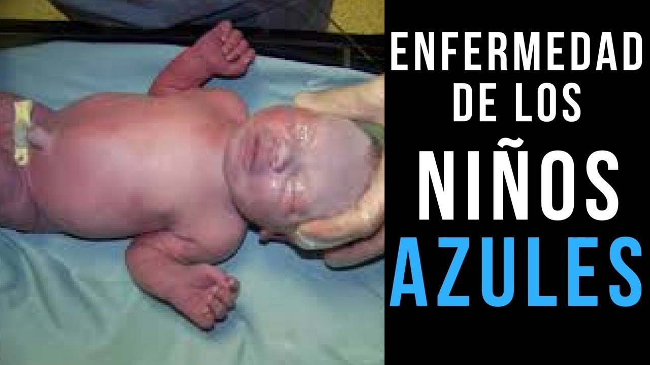 TETRALOGÍA DE FALLOT | Defectos, crisis hipoxémicas, síntomas, causas, dx, tto | Mentes Médicas