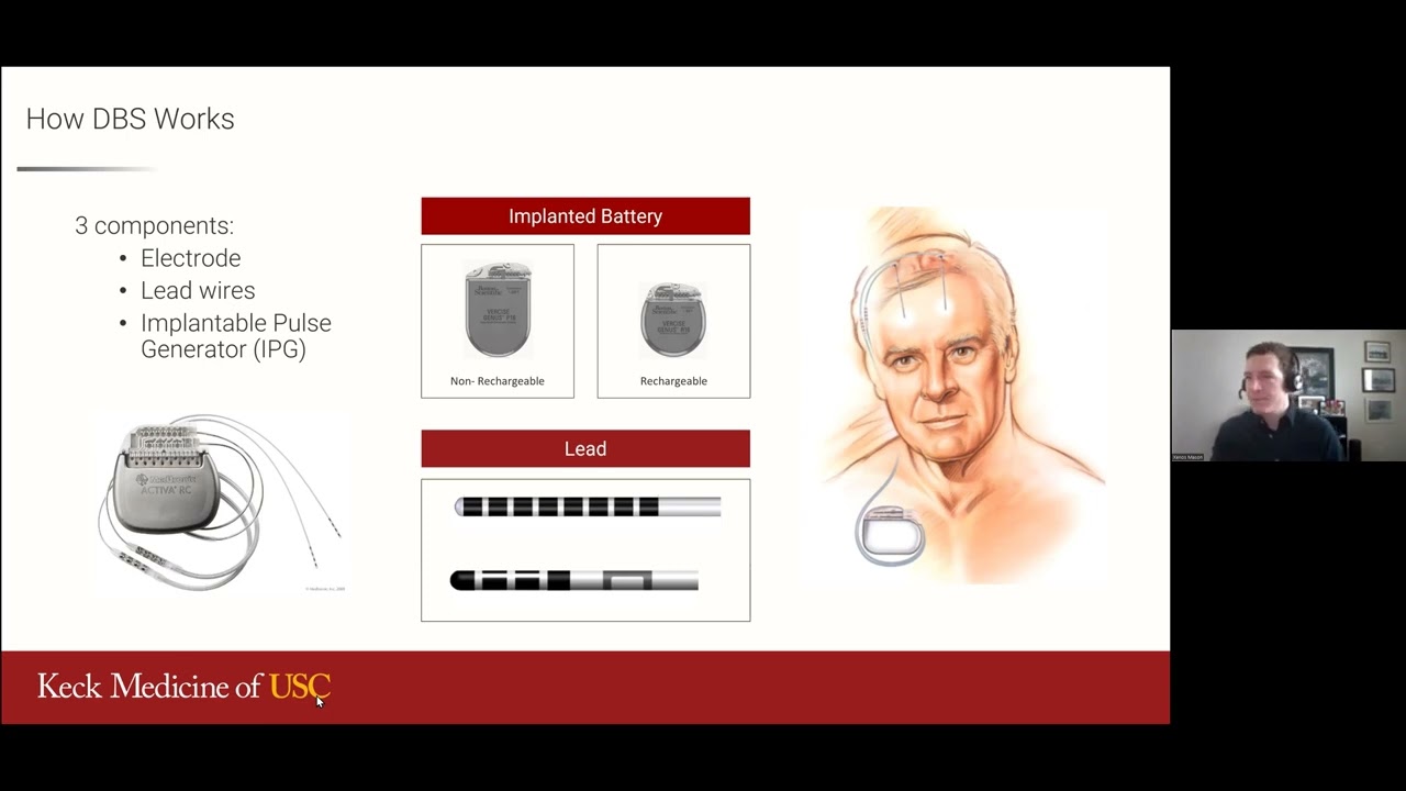 Deep Brain Stimulation (DBS) for Parkinson's Disease: Choosing a Device and Surgeon