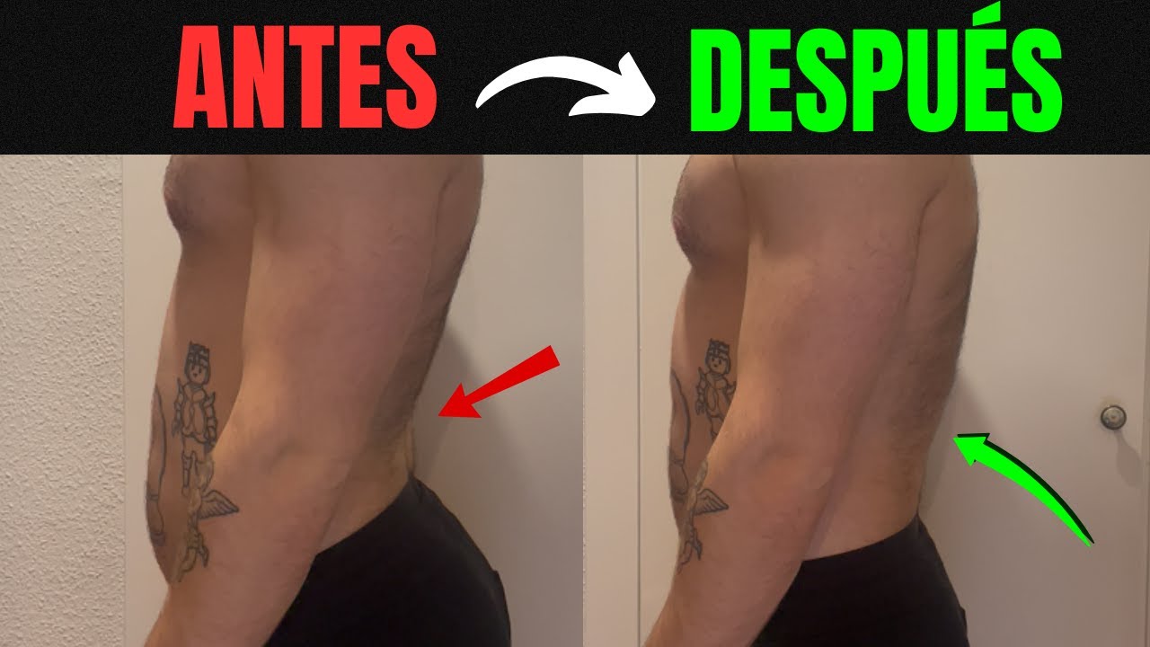 HIPERLORDOSIS LUMBAR | 3 EJERCIOS Para CORREGIR la HIPERLORDOSIS LUMBAR