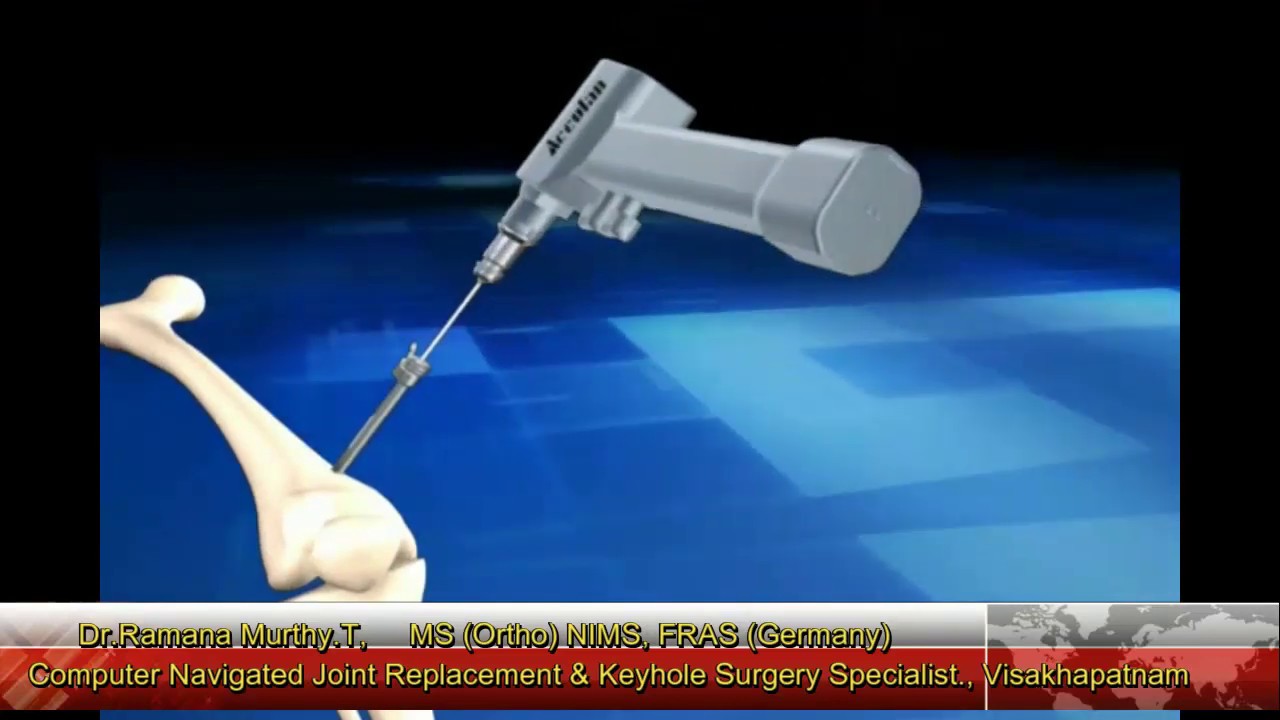 Total Knee Replacement Animation