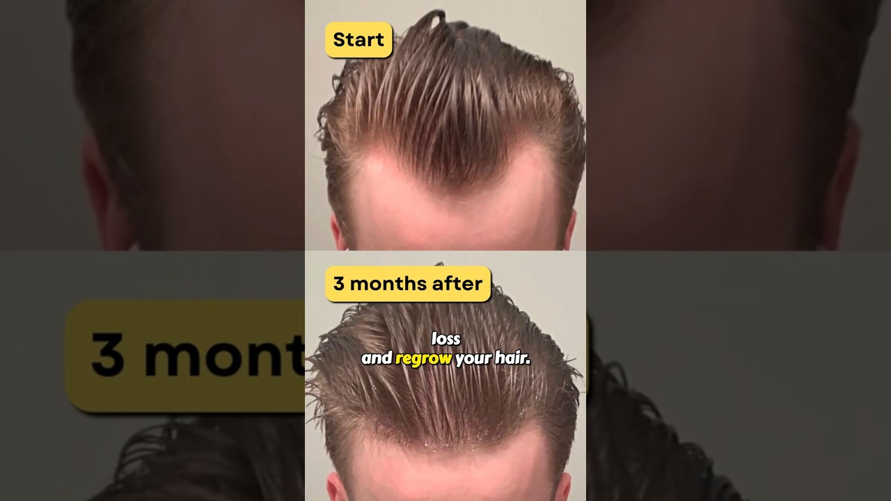 Best 5 Hair Loss Treatments (Ranked!)