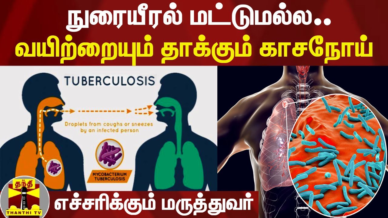 நுரையீரல் மட்டுமல்ல.. வயிற்றையும் தாக்கும் காசநோய் - எச்சரிக்கும் மருத்துவர்| World Tuberculosis Day