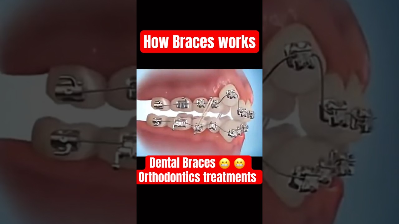 Orthodontic treatment transitions, Braces