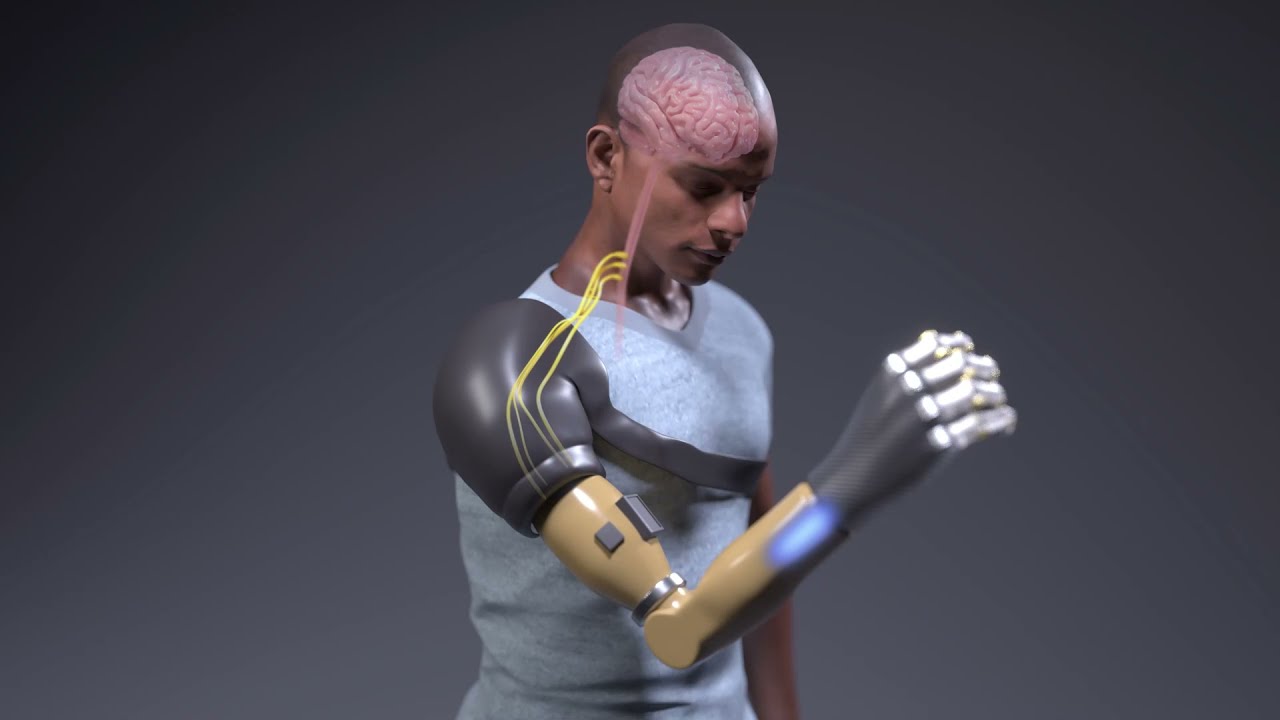 Bionic Arm Restores Natural Behaviors in People with Amputations