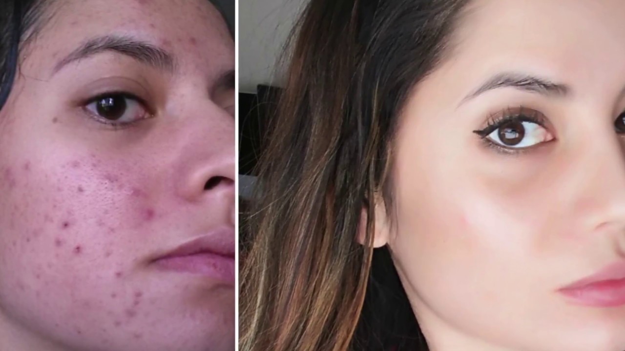 RETIN A RESULTS | 8 MONTH UPDATE