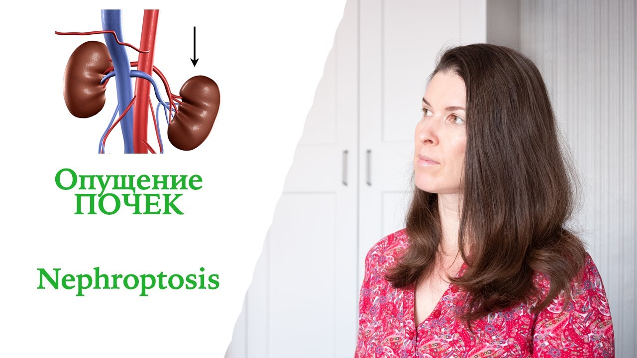 Опущение Почек. Мой Опыт. Нефроптоз  /1/  Nephroptosis. My case.