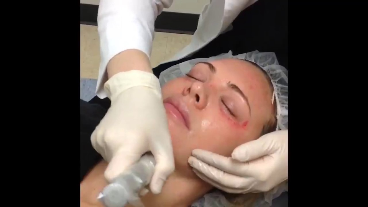 Full Face Microneedling Demonstration | Nashville Licensed Aesthetician