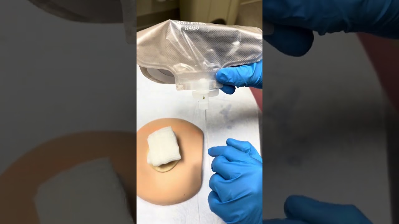 Ostomy Pouch Change with Eakin