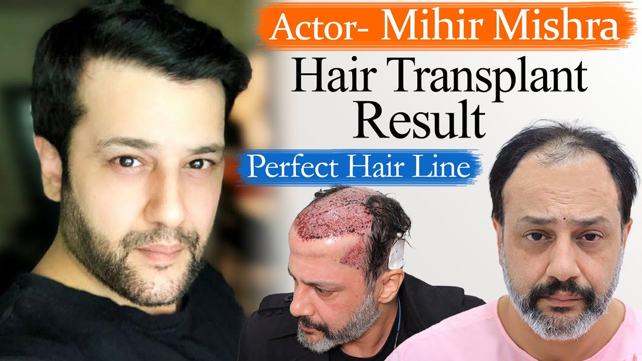 Hair Transplant in India | Best Results & Cost | Medispa India | Celebrity MIHIR Mishra