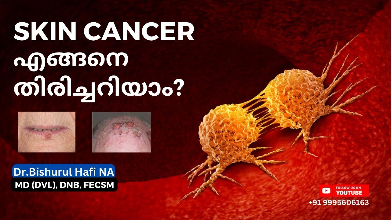Skin cancer എങ്ങനെ തിരിച്ചറിയാം? Dr Bishurul Hafi MD