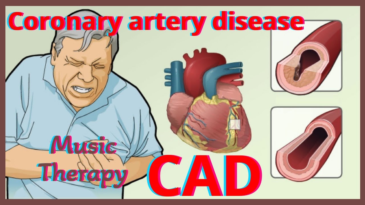 Heart Problems? Heart disease! Coronary artery disease[CAD] Music Therapy + Recommendations.