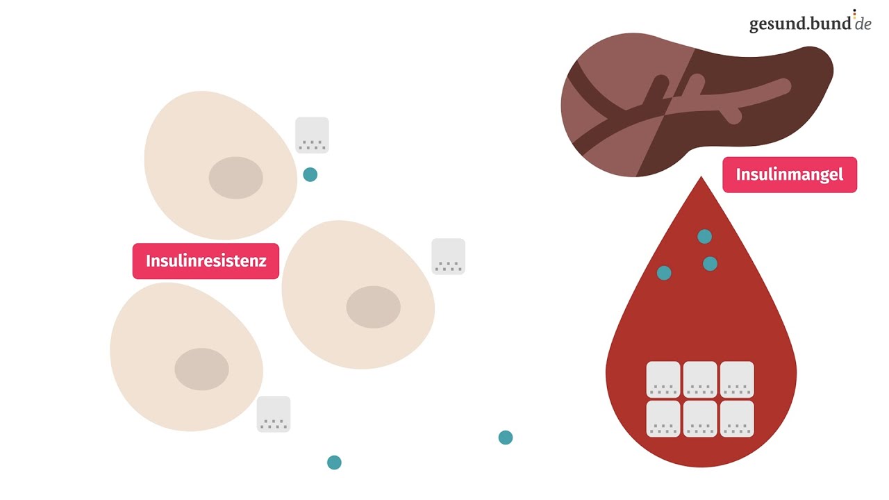 Was ist Typ-2-Diabetes?