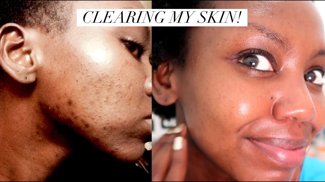 CLEARING MY SKIN - I tried the 10 Step Korean Skin Care Routine || Patricia Kihoro