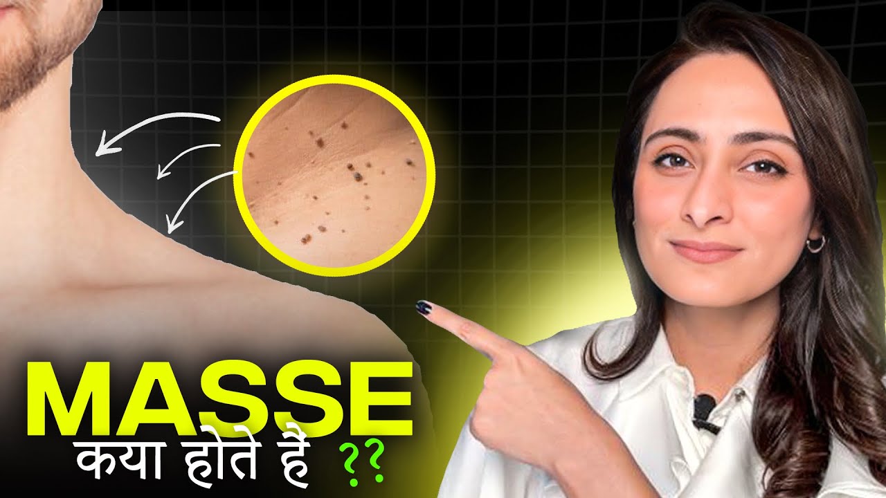 Masse | Skin tags| Kyun hota hai ? kaise treat kare