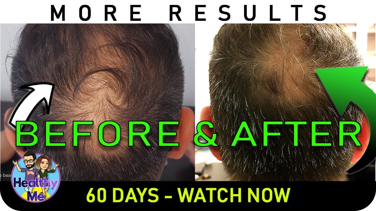 Onion Juice Hair Regrowth - New Pics - 60 Days Before & After Results!